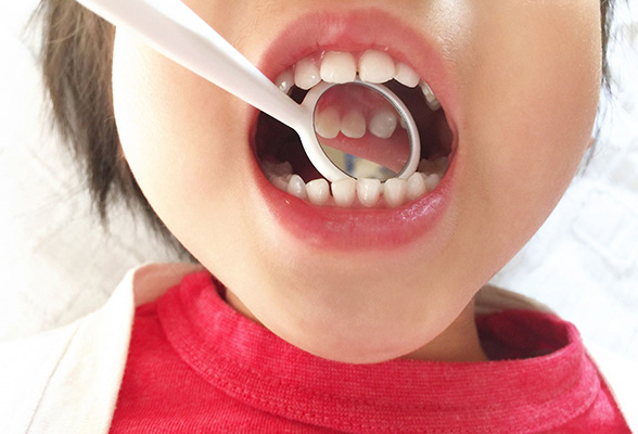 歯の生え変わりの時期はとくに注意が必要です