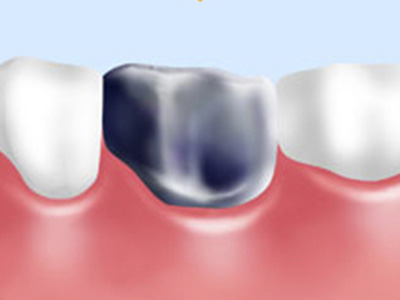 銀歯（保険診療）
